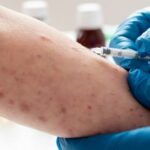 INS habla sobre sarampión en Colombia: casos, síntomas y vacunas